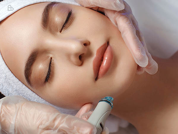 Microneedling radiofrequency treatment performed by dermatologist for skin tightening and scar repair