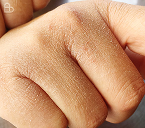 Dry, flaky skin condition treated by dermatologist at Atmos Derm Skin Clinic Kozhikode