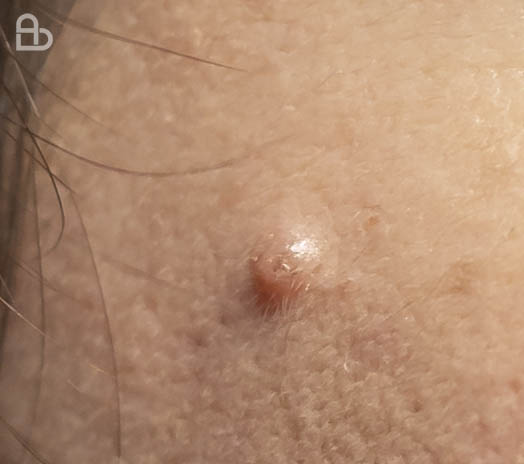 Dermatologist examining a suspicious skin mole during a clinical skin check at Atmos Derm
