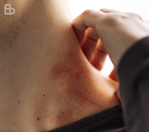 Clinical image representing facial redness and inflammation seen in rosacea patients