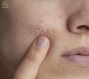 Eczema causing red, itchy, inflamed skin treated by dermatologists at Atmos Derm Skin Clinic Kozhikode