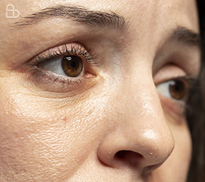 Dermatology treatment for common skin warts using medical procedures at Atmos Derm clinic