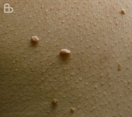 Dermatology treatment for common skin warts using medical procedures at Atmos Derm clinic