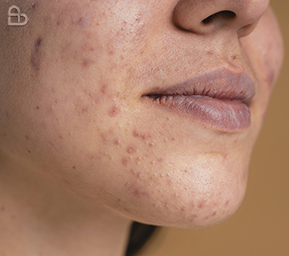 Active acne with blackheads, whiteheads, and inflamed pimples treated at Atmos Derm Skin Clinic Kozhikode
