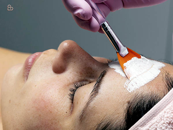 Customized chemical peel treatment for acne and pigmentation